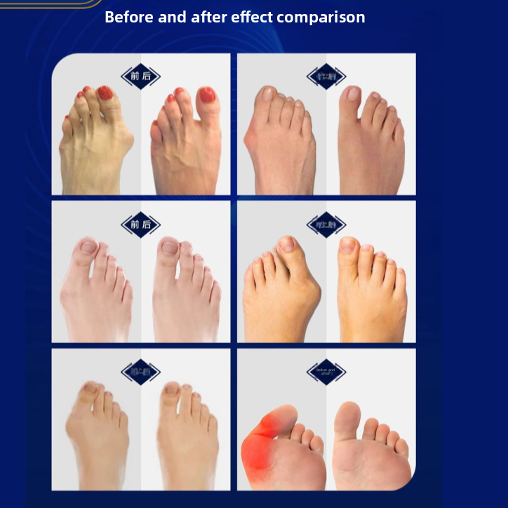 Adjustable Silicone Toe Corrector for Bunion Relief